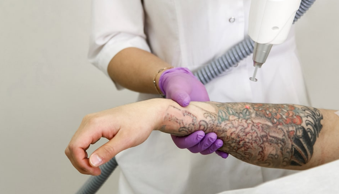 Laser Tattoo Removal Specialist In Chandigarh Book An Appointment   Tattoo Removal 